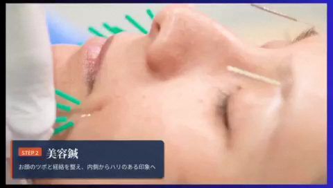 STEP2 美容鍼の様子