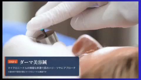 STEP3 ダーマ美容鍼(マイクロニードル機器)の様子